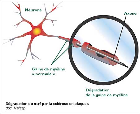 Dégradation du nerf par la sclérose en plaques